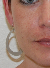 Facial filler patient in San Antonio